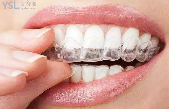 我在拜瑞口腔醫(yī)院做的時(shí)代天使矯正被夸了！