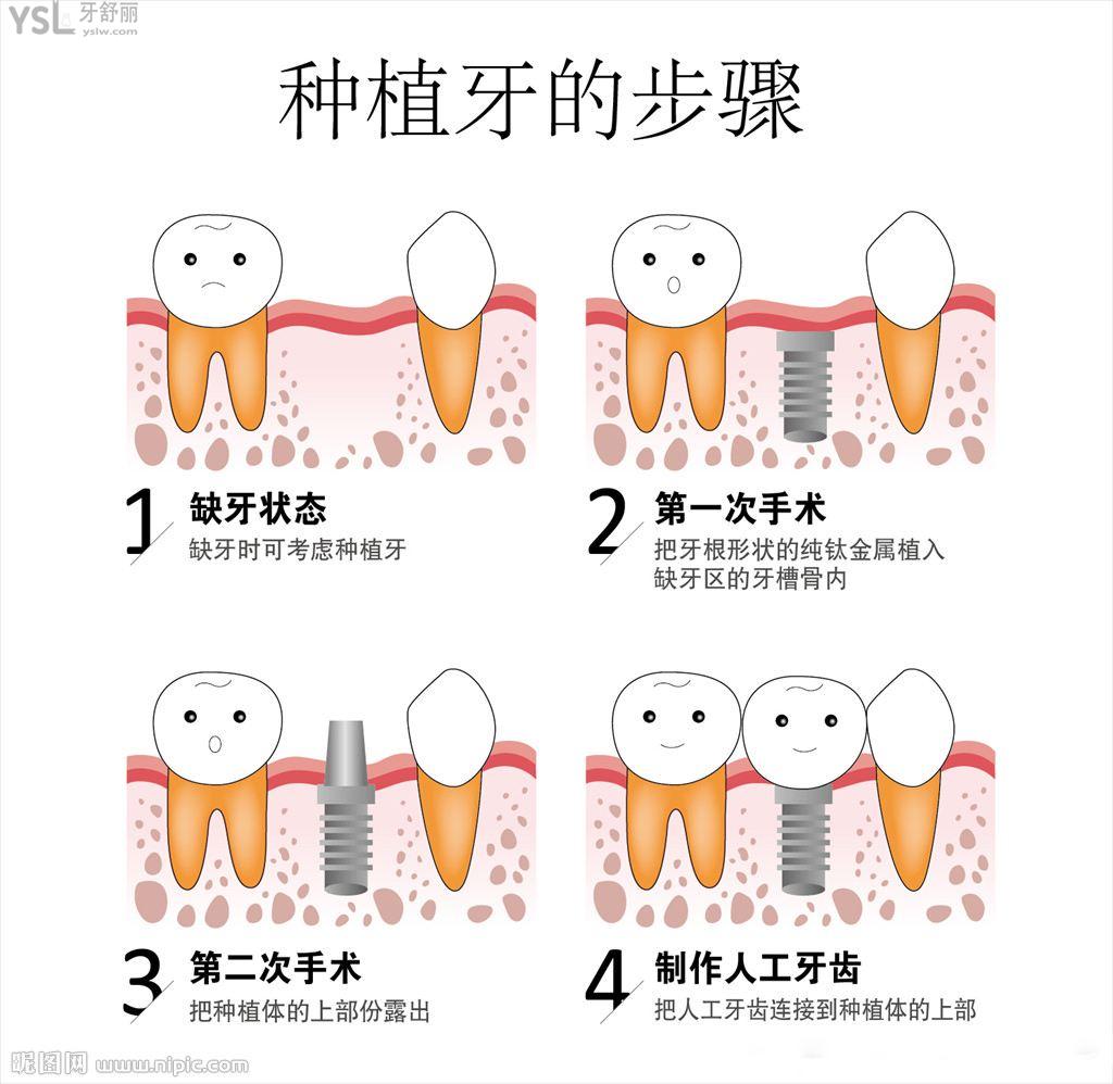 種植牙的步驟