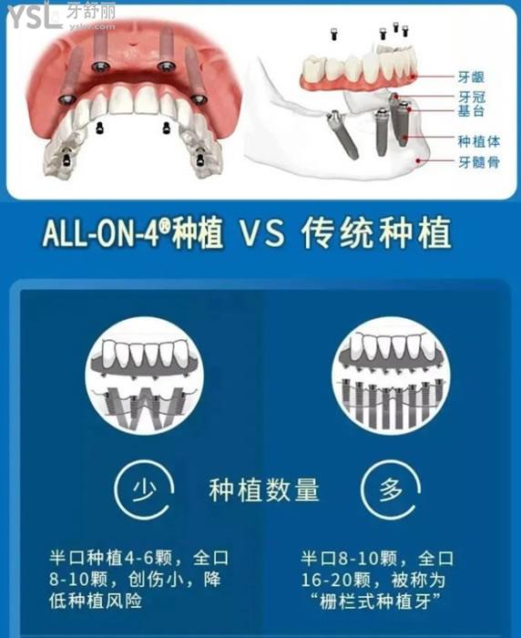 all-on-4種植技術(shù)與傳統(tǒng)種植對比