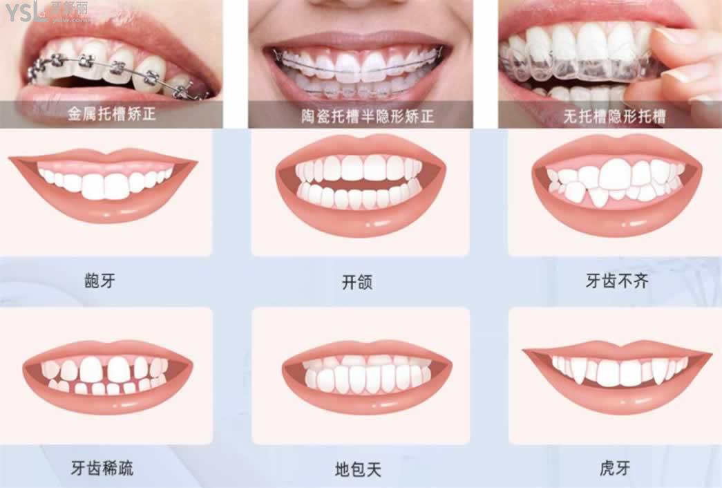 正畸后注意事項(xiàng)