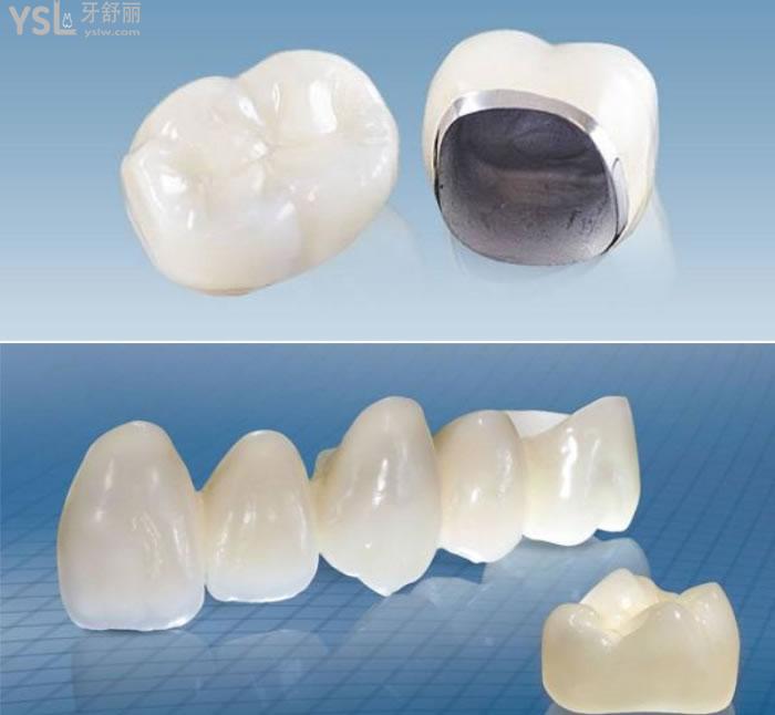 昆明全瓷牙套多少錢一顆價(jià)格表