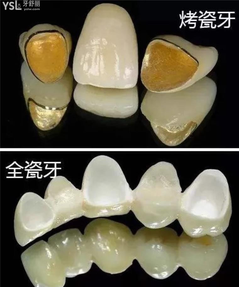 昆明全瓷牙套多少錢一顆價(jià)格表