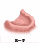 allon4和allon6半全口種植牙區(qū)別