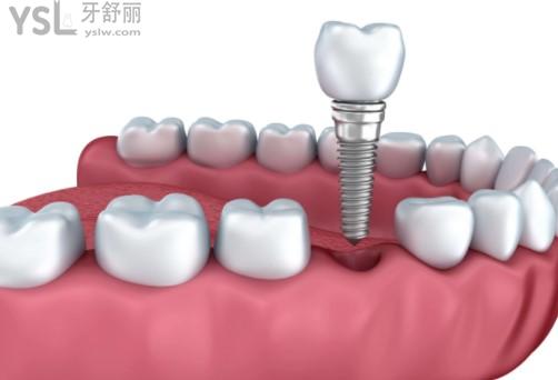 佛山種植牙收費(fèi)標(biāo)準(zhǔn)全口半口種牙費(fèi)用貴嗎