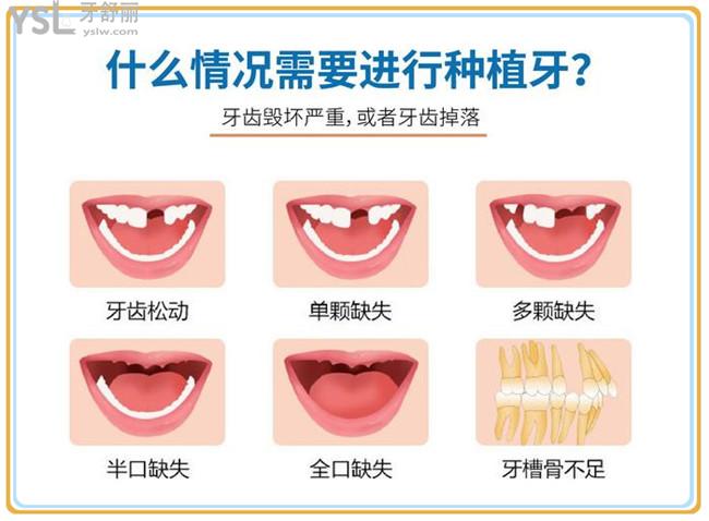什么情況需要種植