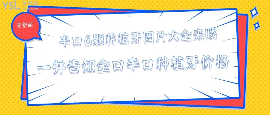 半口6顆種植牙圖片大全，全口半口種植牙價(jià)格