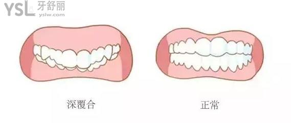 深覆合