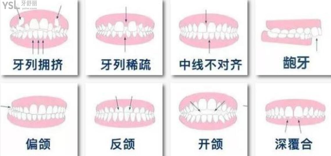 整牙十年后的感受及心得體會