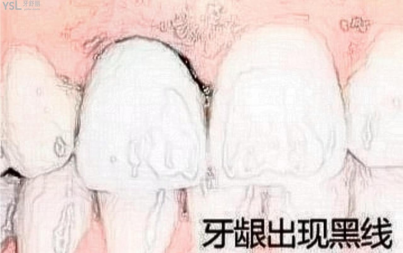 后悔做固定義齒