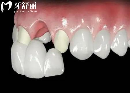 全瓷牙冠