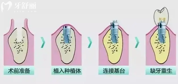 種植體過(guò)程