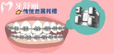 國產和進口牙套種類及價格表