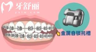 國產和進口牙套種類及價格表