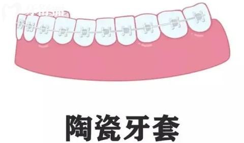 國產和進口牙套種類及價格表