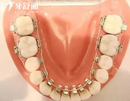 國產和進口牙套種類及價格表