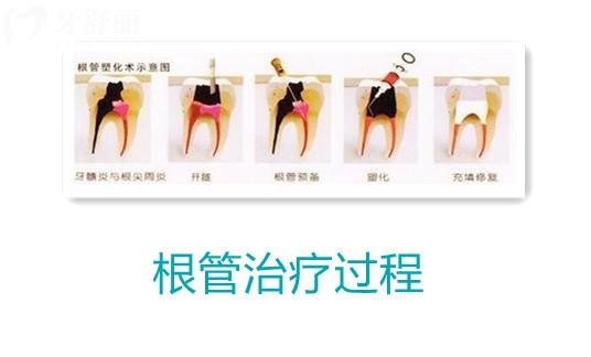 為什么牙醫(yī)都推薦做根管治療？牙疼就一定要做嗎？