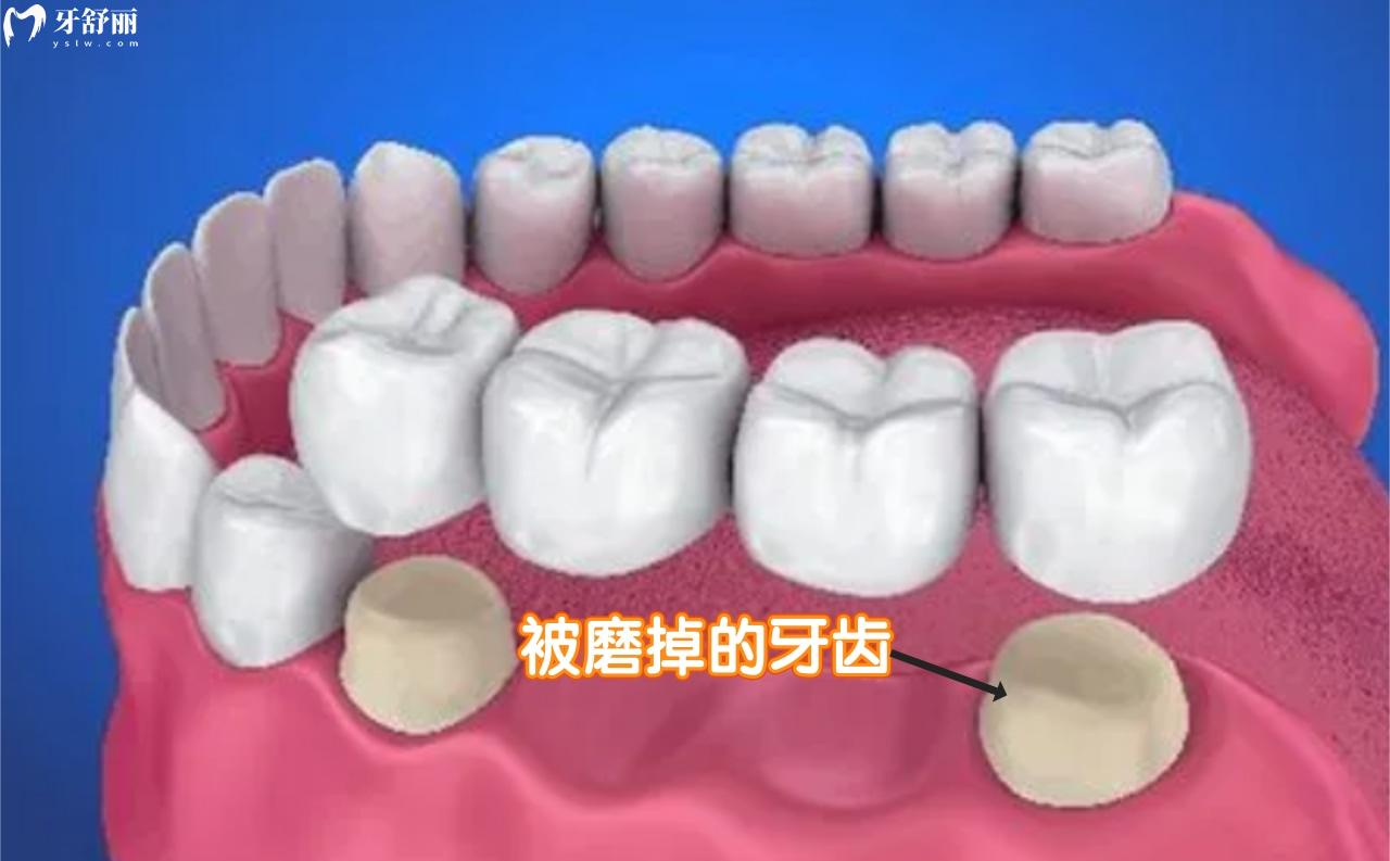 為什么戴牙套要磨掉兩邊的牙齒
