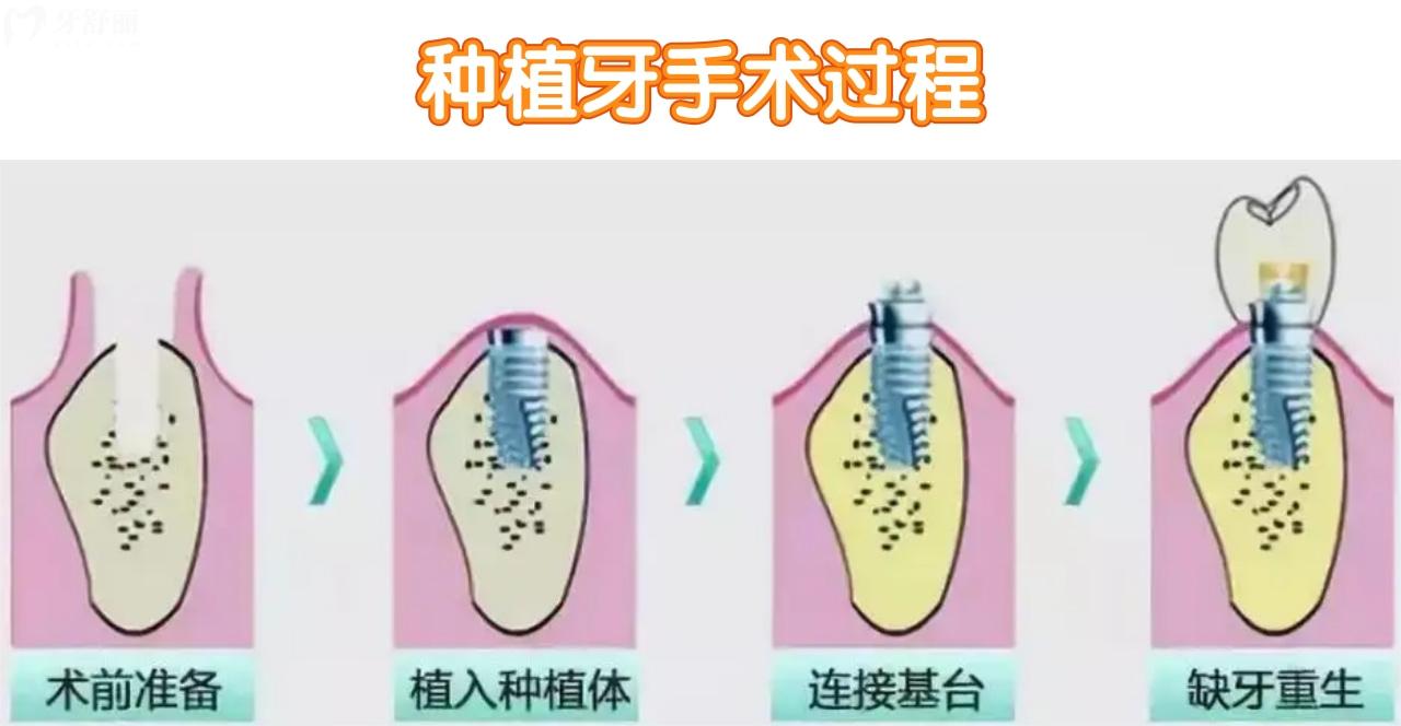 種植牙手術(shù)流程