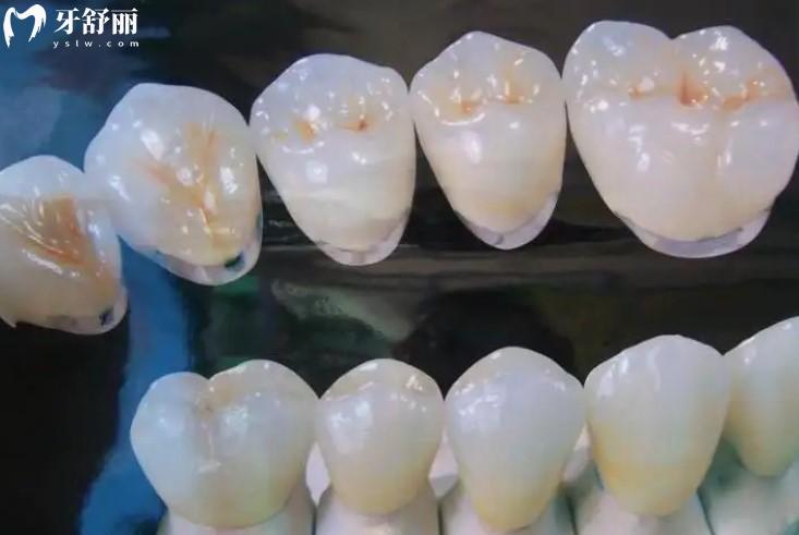 鈦合金烤瓷牙