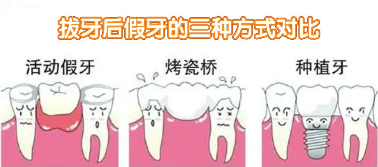 缺牙后的三種假牙方式