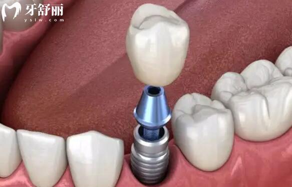 德國icx種植牙是什么檔次的?.jpg