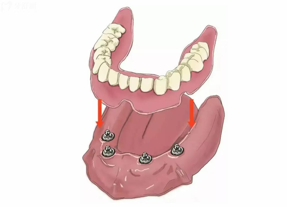 半口半固定種植牙