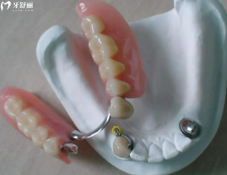 活動(dòng)義齒
