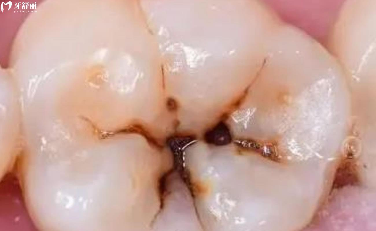 蟲牙是牙齒的蟲子嗎圖片