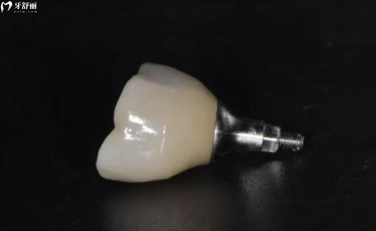 西班牙泰科種植牙是什么材質(zhì)