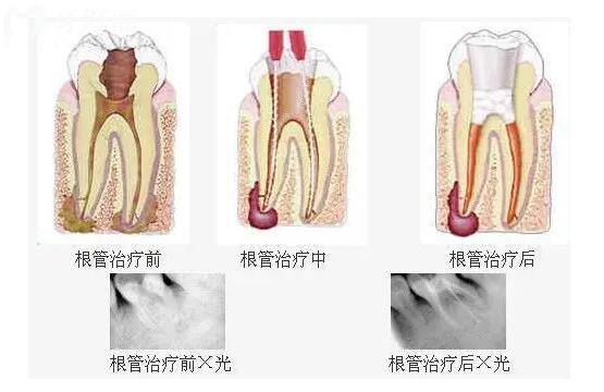 根管治療7年了沒做牙套會怎樣?良心醫(yī)生不會說的根管秘密.jpg