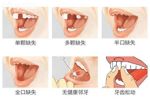 老媽到牙科做種植牙,醫(yī)生為什么說上門牙不建議種植!.jpg