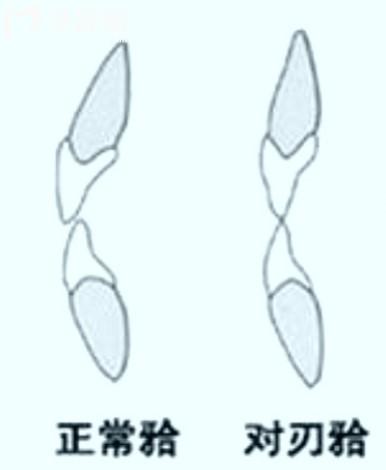 正常頜和對刃頜圖片