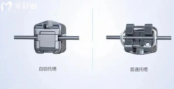 普通牙套和自鎖牙套