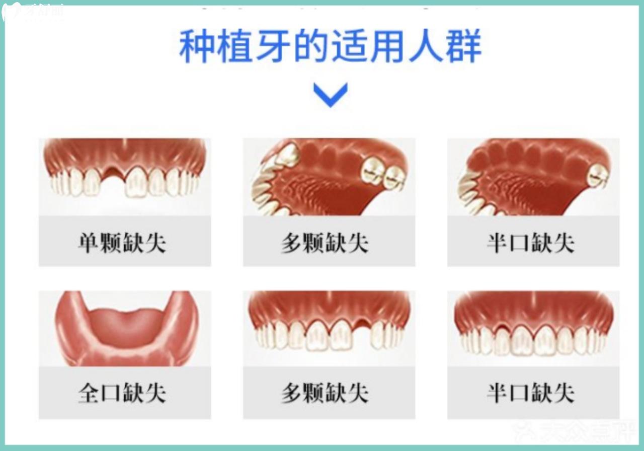 種植牙適合哪些人群？