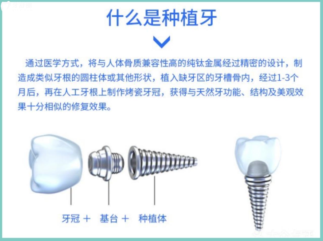 種植牙的組成部分