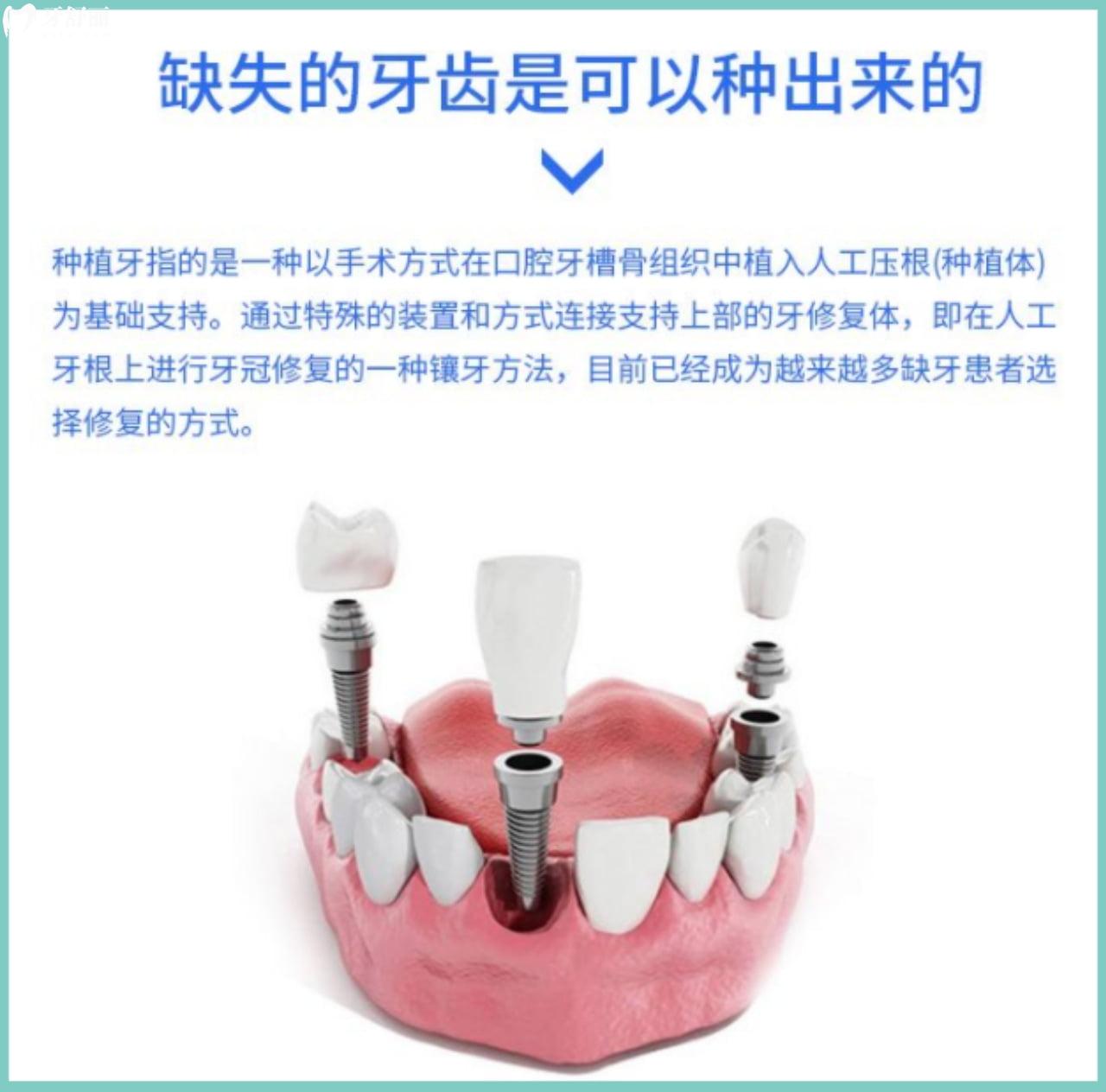 牙齒缺失及時(shí)補(bǔ)種