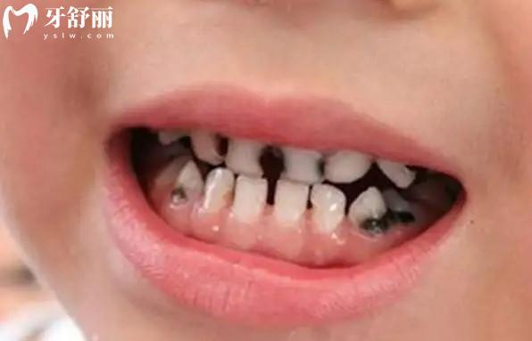 寶寶齲齒
