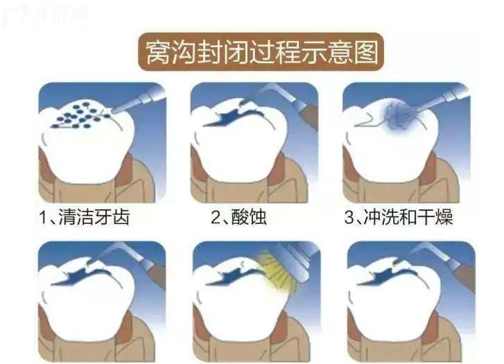 窩溝封閉過程圖