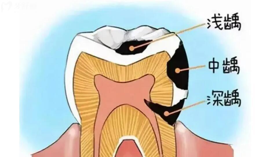 牙齒中間有一點(diǎn)點(diǎn)黑要補(bǔ)牙嗎圖片,一位牙醫(yī)的忠告!.jpg