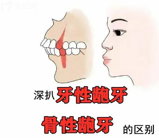 牙性齙牙和骨性齙牙的區(qū)別