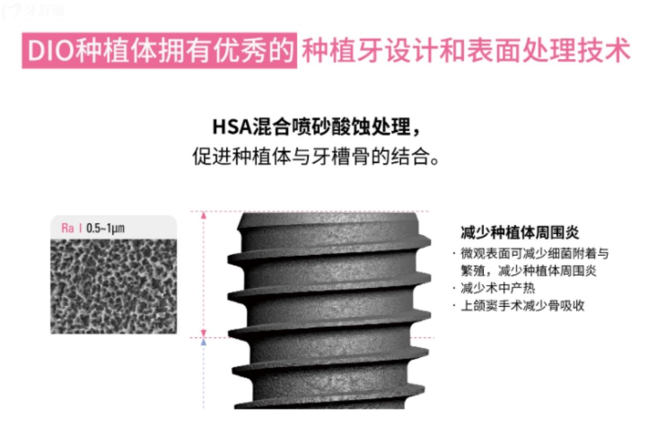DIO種植牙表面處理技術