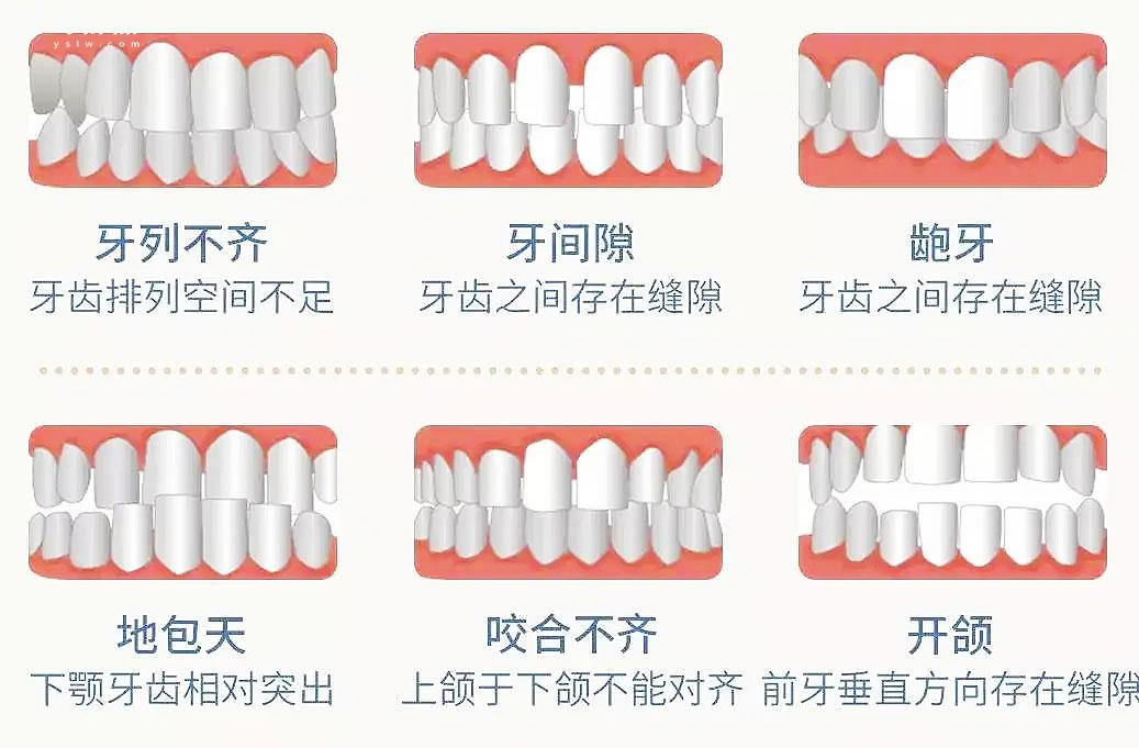 牙套究竟怎么選擇好壞，什么樣的人像我一樣需要正畸呢