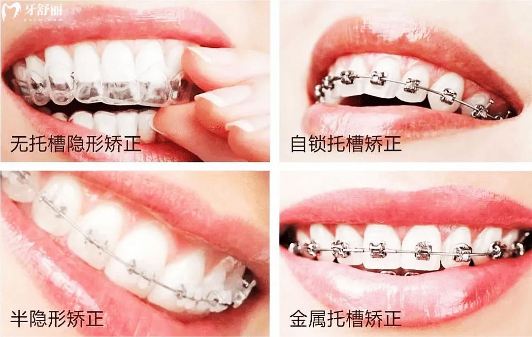 牙套究竟怎么選擇好壞，什么樣的人像我一樣需要正畸呢