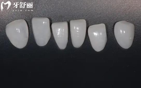 牙貼面
