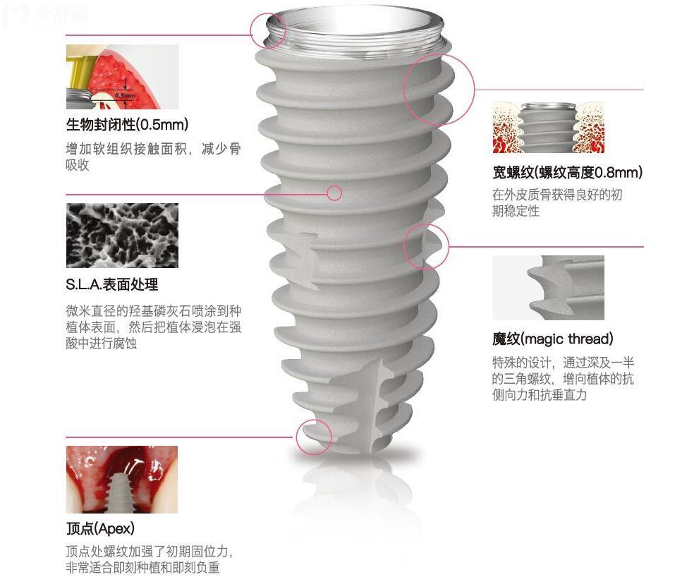 韓國(guó)紐百特種植牙質(zhì)保幾年?究竟質(zhì)量怎么樣?.jpg