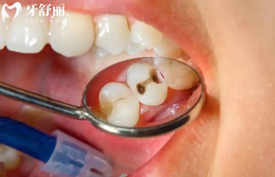 陶瓷材料補牙