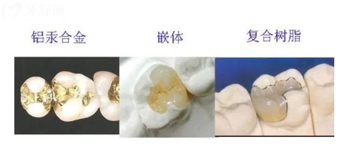 補牙材料
