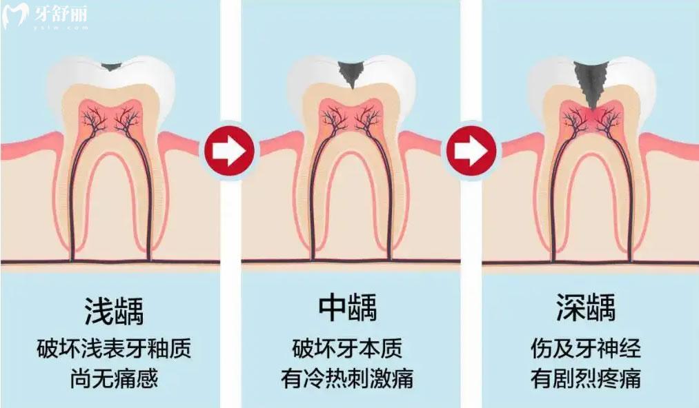 蛀牙的發(fā)展過(guò)程