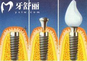 瑞士iti種植牙是什么檔次的?瑞士士卓曼種植牙多少錢一顆.jpg