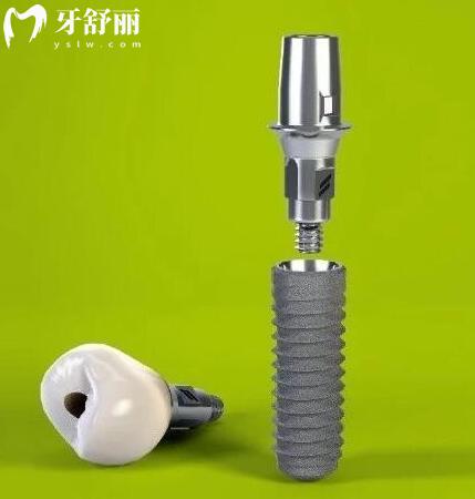瑞士iti種植牙是什么檔次的?瑞士士卓曼種植牙多少錢一顆.jpg